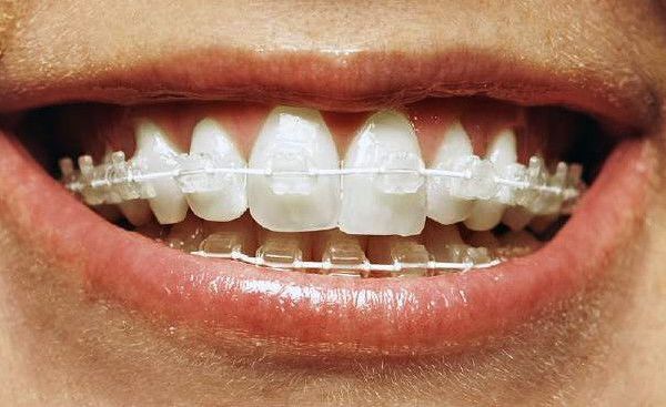 Orthodontic braces