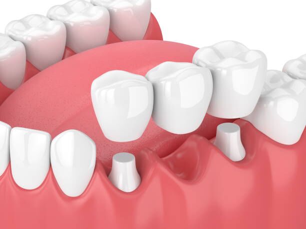 Dental bridge restoration