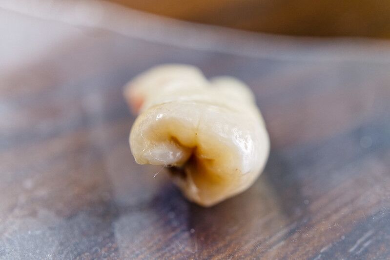 Tooth extraction procedure