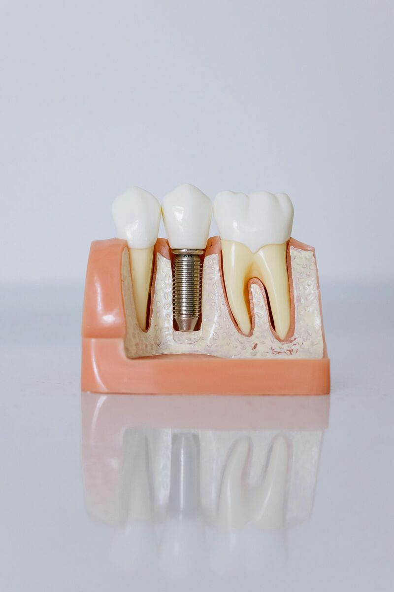 Dental implant placement