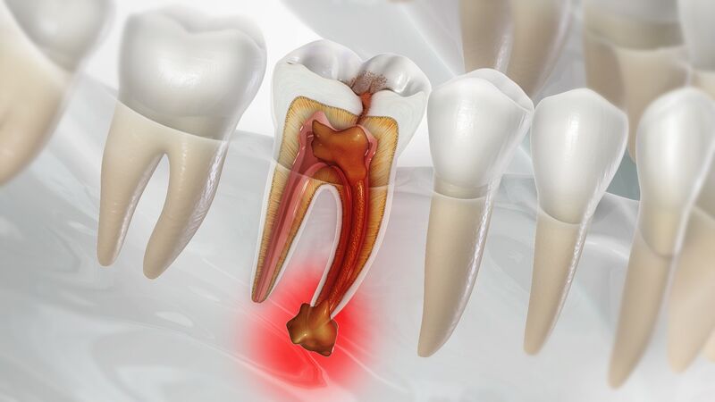 Root canal treatment