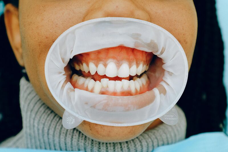 Professional teeth whitening